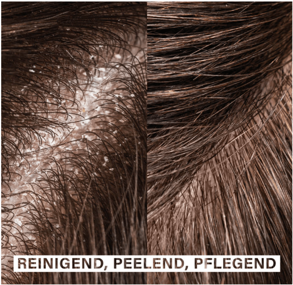 Close-up comparison of scalp before and after using Exfoliating Hydrating Hair Bar Duo